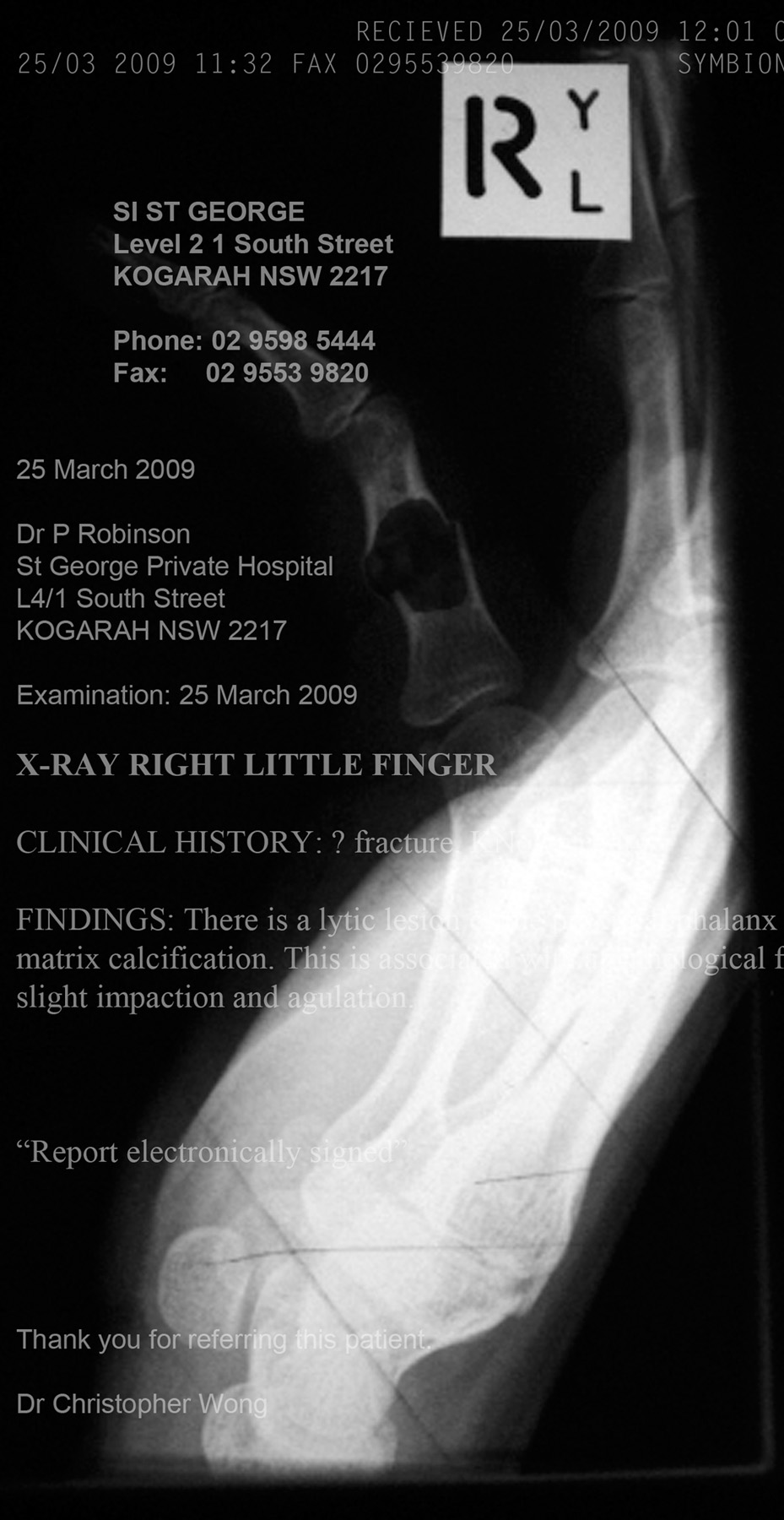Failing the right hemisphere
